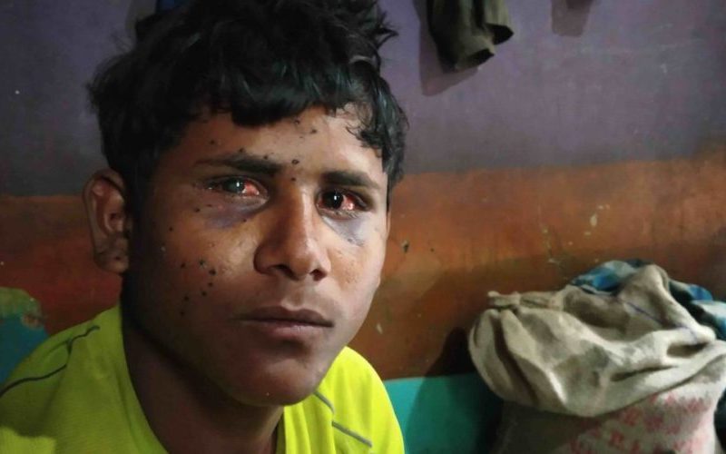 Bihari laborer Shahanbaz : A new victim of pellets in Kashmir